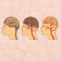 CT Brain Perfusion Basics